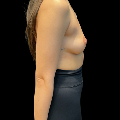 Breast Augmentation Before & After Patient #14376