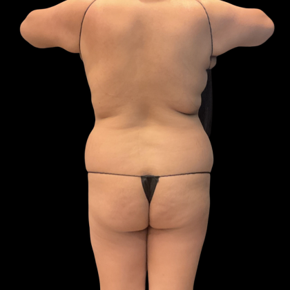 Fat Transfer Before & After Patient #14378