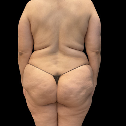 Mastopexy Before & After Patient #14379