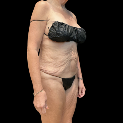 Fleur De Lis Tummy Tuck Before & After Patient #14384