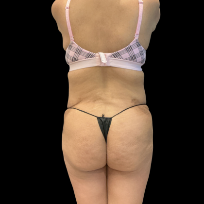 Fat Transfer Before & After Patient #14378