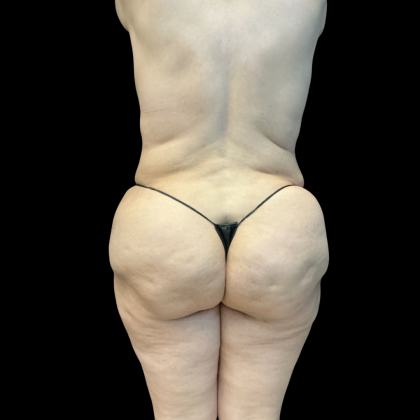 Mastopexy Before & After Patient #14379
