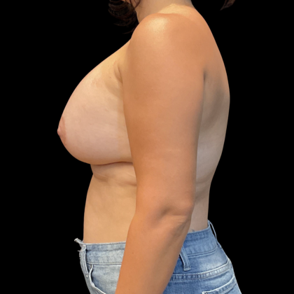 Breast Augmentation Before & After Patient #14381