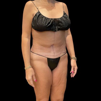 Fleur De Lis Tummy Tuck Before & After Patient #14384