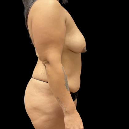 Tummy Tuck Before & After Patient #14387