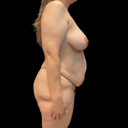 Mastopexy Before & After Patient #14379
