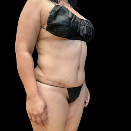 Liposuction Before & After Patient #14383