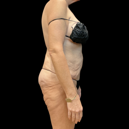Fleur De Lis Tummy Tuck Before & After Patient #14384
